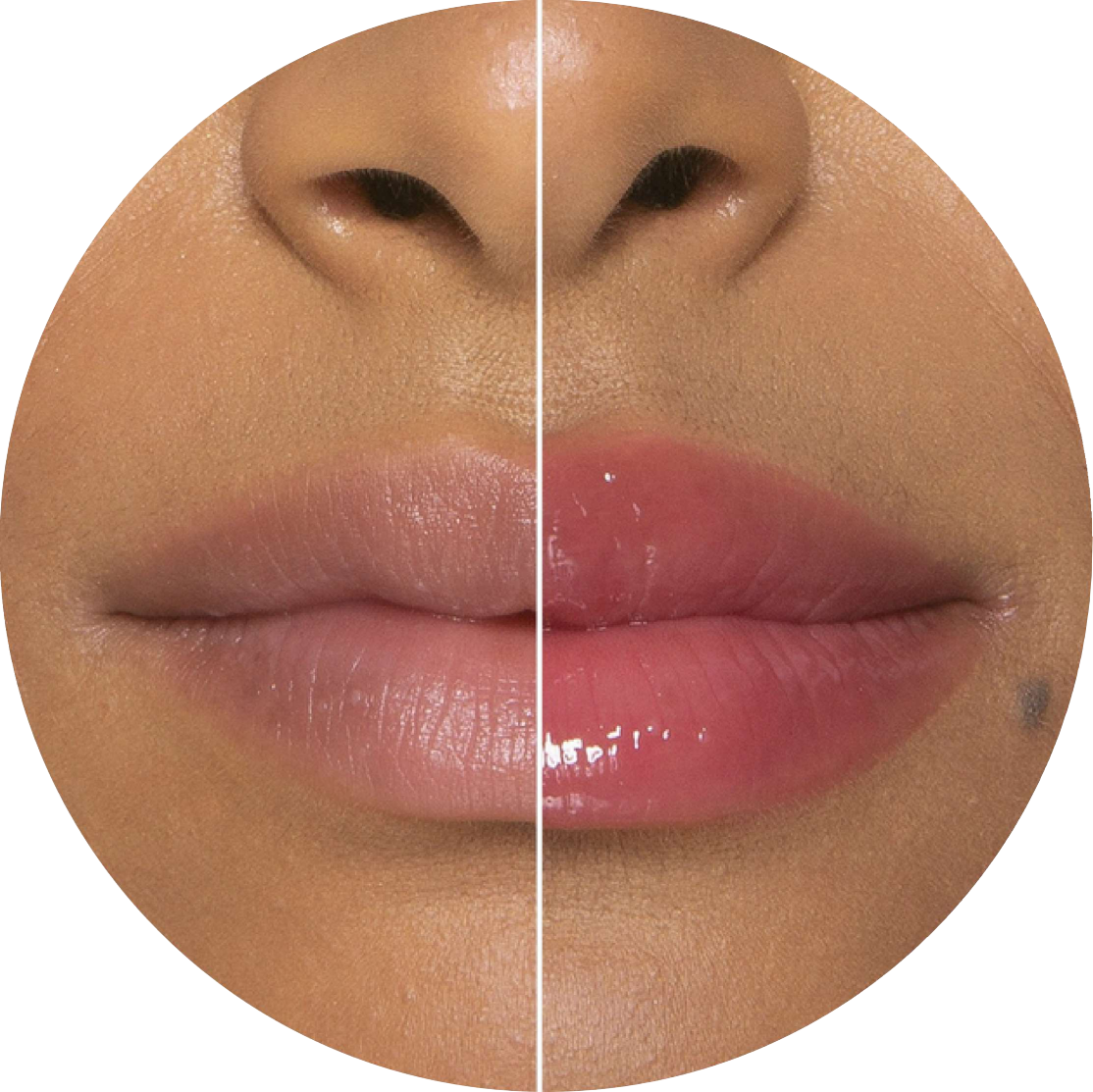 Skinbooster Hydra Gloss - hidratação profunda dos lábios na Anand Clínica